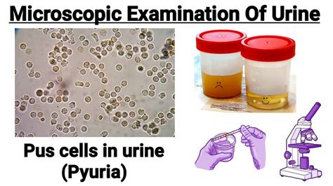 pus cells in urine normal value|Pyuria: Causes, Symptoms, Management & Treatment.